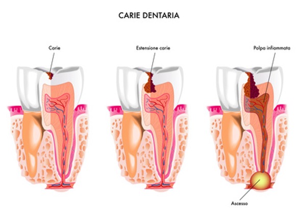 immagine dente cariato fino a radice