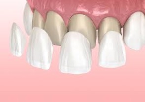 immagine applicazione faccette sopra i denti