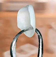 immagine di una faccetta dentale