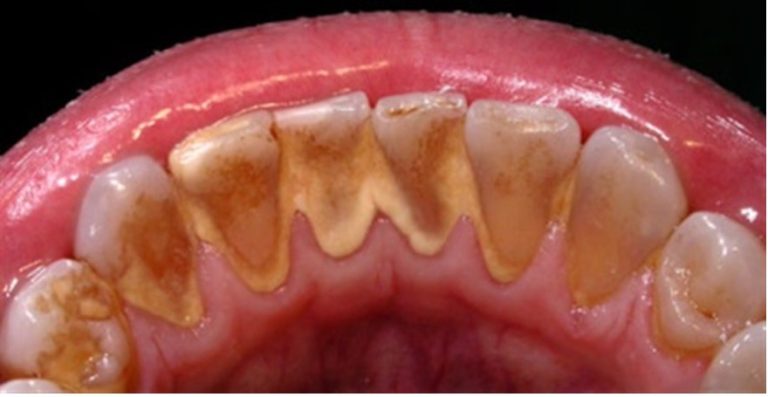 foto di denti con molta placca