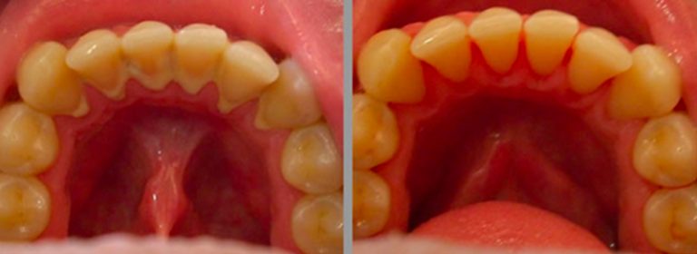 foto di denti prima e dopo l'igiene dentale professionale