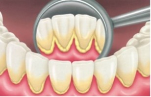 disegno denti con placca