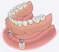 disegno tecnica OVERDENTURE con pilastro a pallina