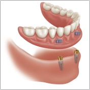 disegno tecnica OVERDENTURE con pilastro locator