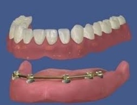 disegno tecnica OVERDENTURE con pilastro per barra