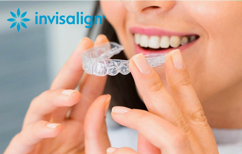 donna che indossa apparecchio trasparente invisalign