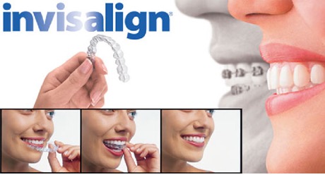 donna che indossa apparecchio trasparente o mascherina invisalign