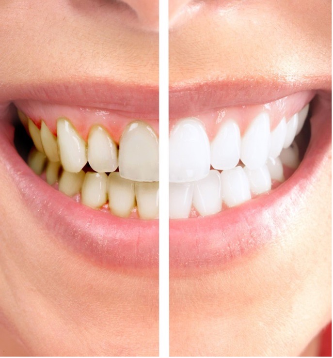 foto sorriso contrasto denti gialli e bianchi dopo sbiancamento